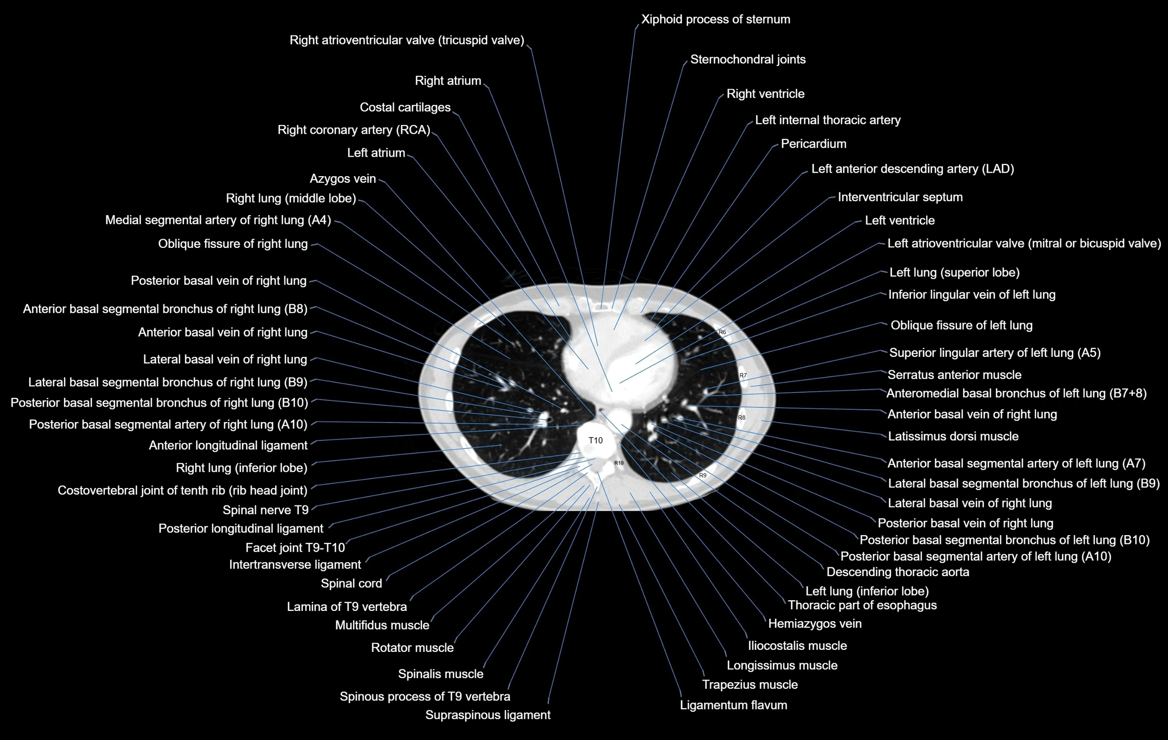 CT chest (thorax) lung window window labelled axial cross sectional anatomy radiology image-00081.webp
